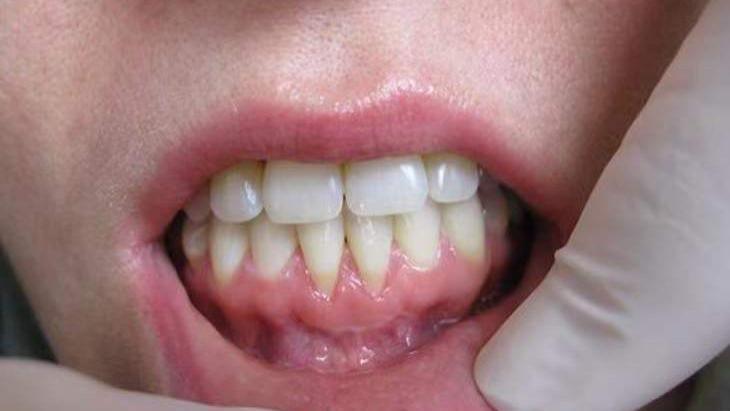 食管癌|为什么牙齿松动脱落，大多数都是中老年人？