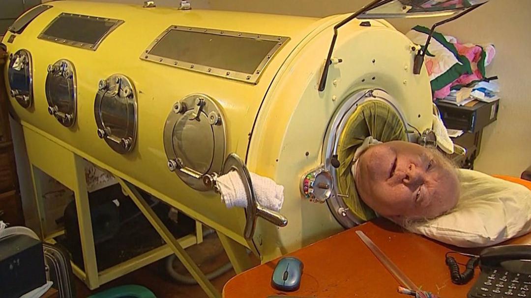 感冒|肺人被困在“铁桶”70年，无法自主呼吸，停电就意味着死亡