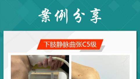 静脉曲张|静脉曲张溃烂术后效果如何？