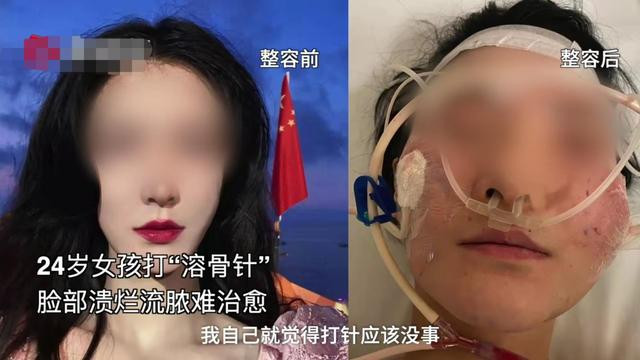 女孩 美容变毁容！24岁女孩打1700美容针后脸溃烂流脓，花10万久治不愈
