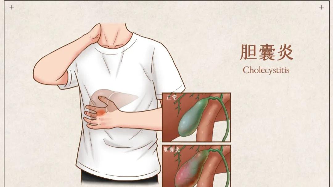 运动|急性胆囊炎突然发作，这些急救方法一定要知道