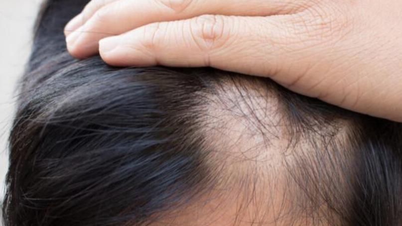 哮喘|胶原蛋白改善头发，能治脱发吗？试试这5种食物，补多了会怎样？