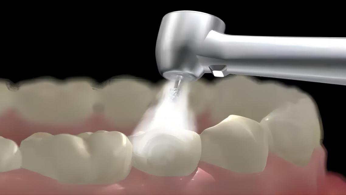 心肌梗塞|洗牙对我们的生活有啥好处呢？