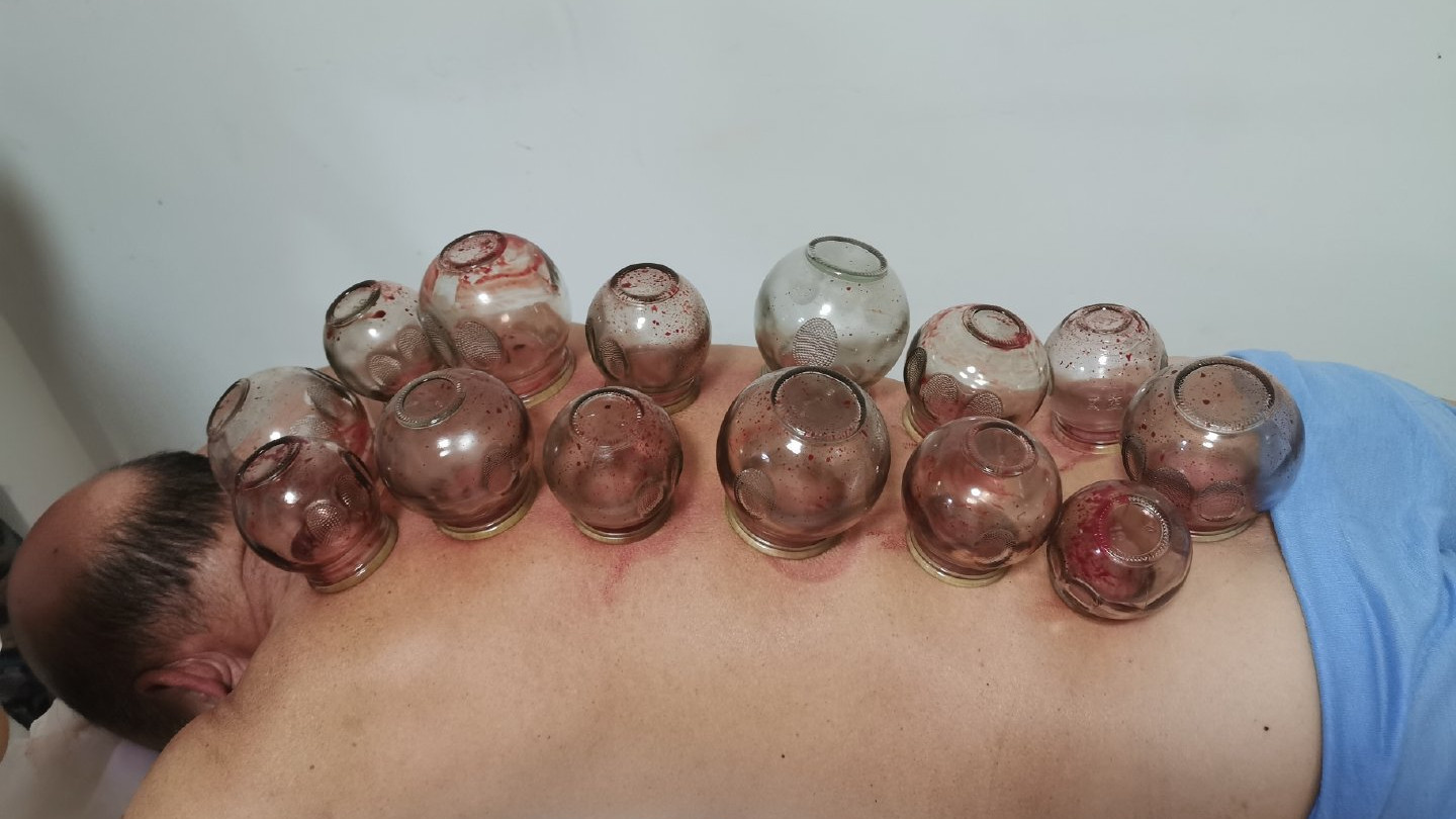 失眠|上火可以拔罐走罐