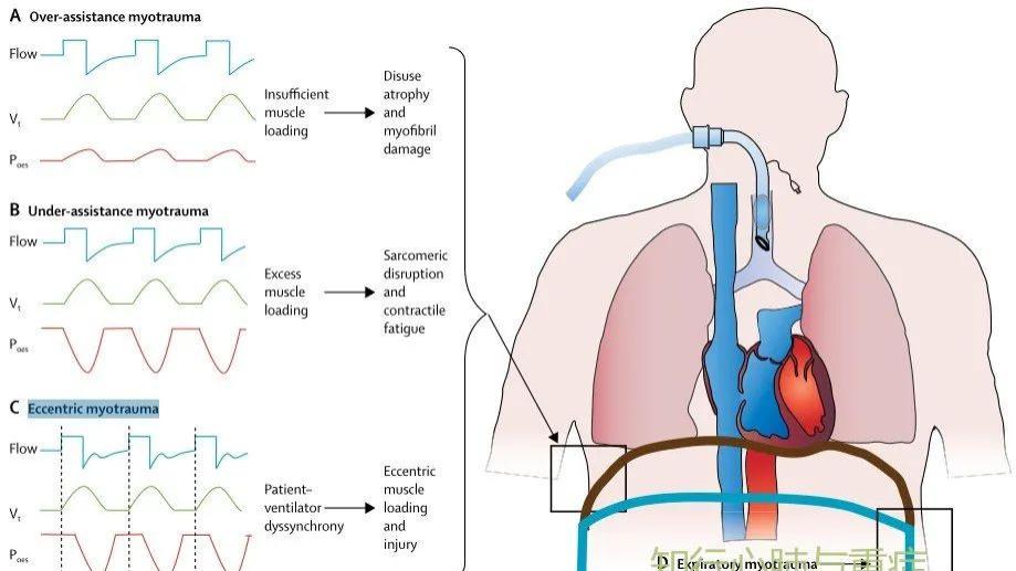 脑梗|重症患者的膈肌功能障碍，9张图全面了解！