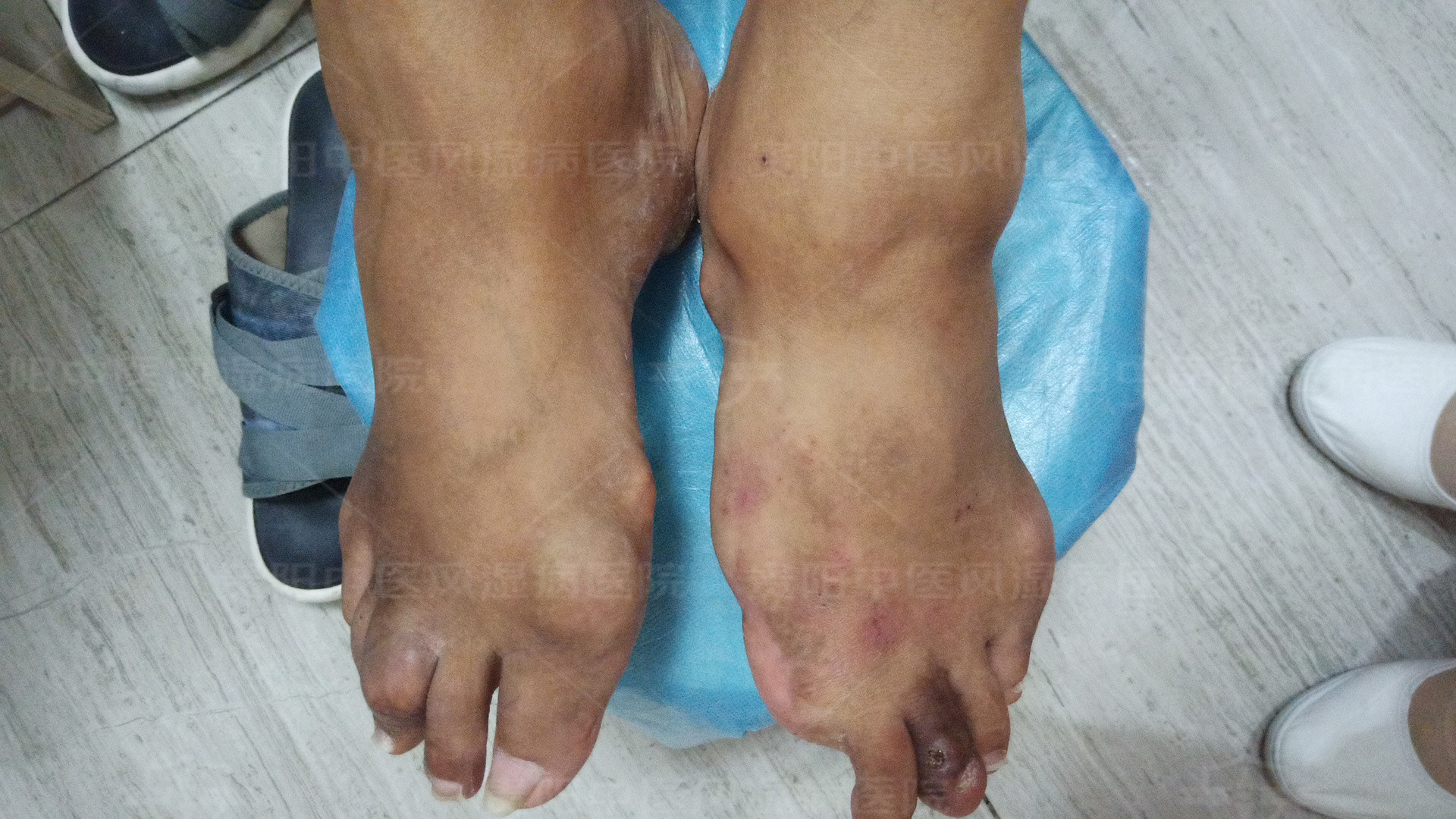 香蕉|巧用这两种方法，不再烦恼痛风