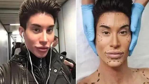 整形|还记得那个整形一百多次的男人吗？花154万给后背植入翅膀，今状况如何？