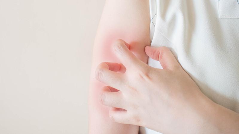 荨麻疹|突然得了荨麻疹太烦人？教你几个止痒小妙招