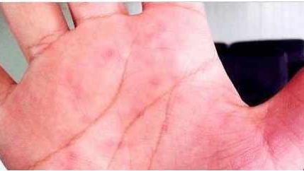 高血压|想知道肝脏好不好？ 伸出“手”来看一看， 别不当回事