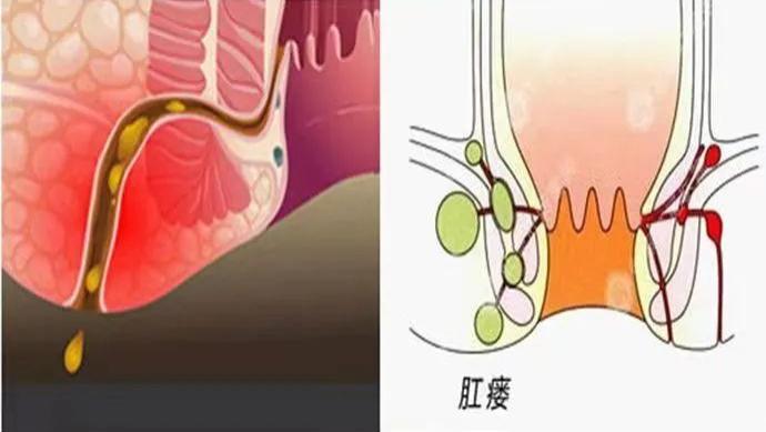 肛瘘|关于肛瘘手术，这七个关键问题一定要知道！