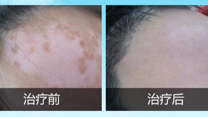 白癜风|白癜风要消失往往会出现5个迹象，对照起来，看看你身上是否出现过吧！