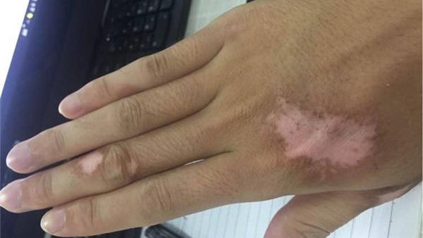 白癜风|日常饮食很重要，白癜风可以这样吃