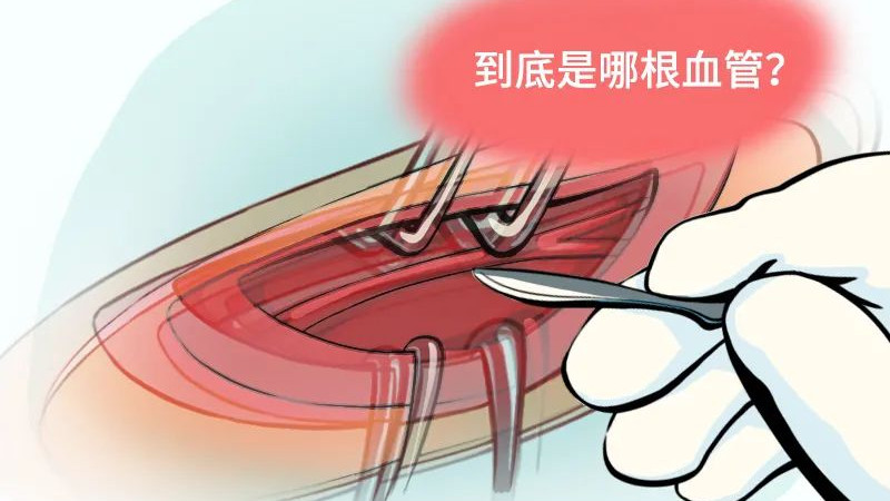 近视|有人手术放屁引起火灾？手术室里还有什么你不知道的事儿？