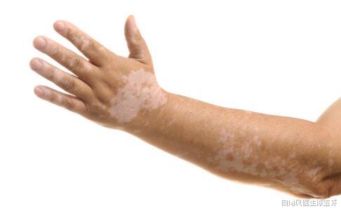 要怎么做才能从根本上预防白癜风疾病?做好这5点