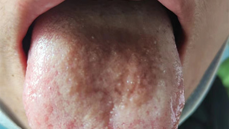 中国科学院|阳了以后舌苔变黑怎么办？