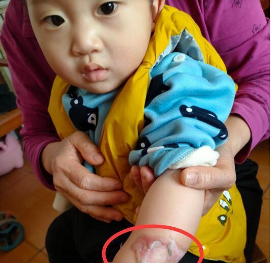 孩子被烫伤, 是该先冲水还是先脱衣服呢? 第一步做错, 伤情更严重