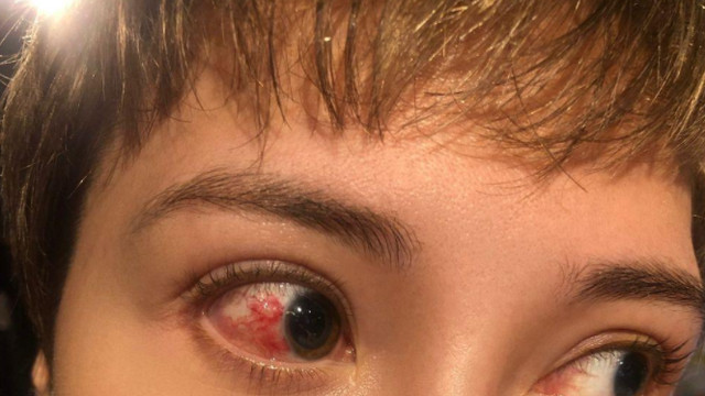 苗侨伟|再出事故，苗侨伟剧组枪战出意外，女演员眼球被弹片擦伤布满血丝