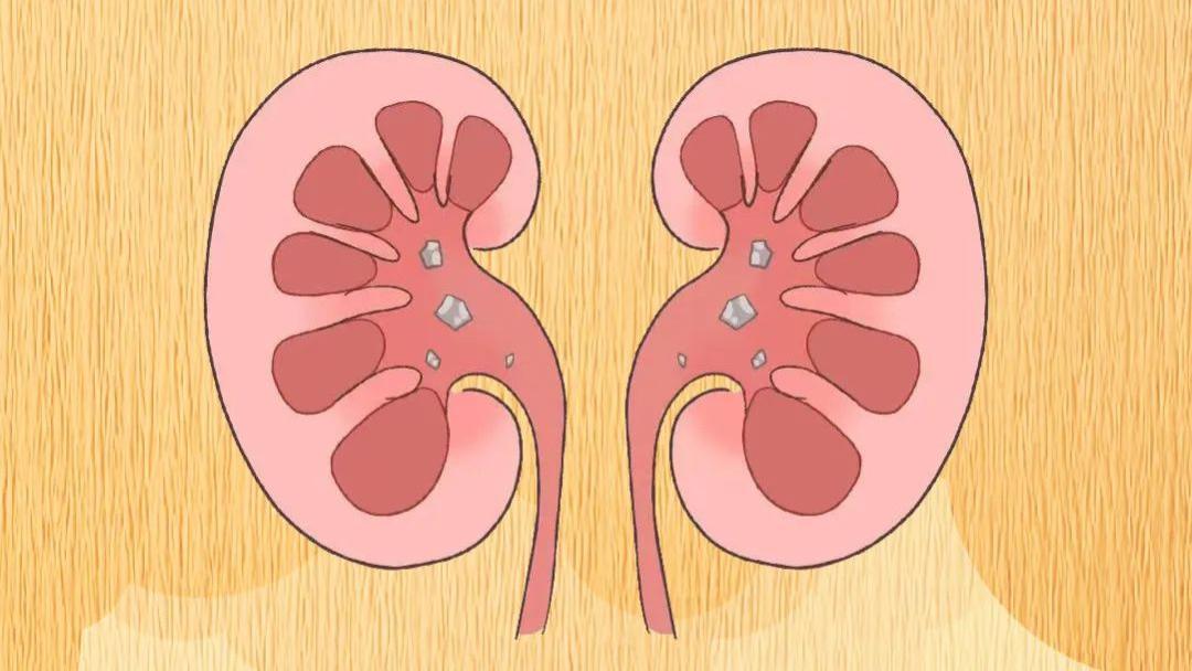 饮食健康|小结石，大危害|一图看懂肾结石的“来龙去脉”