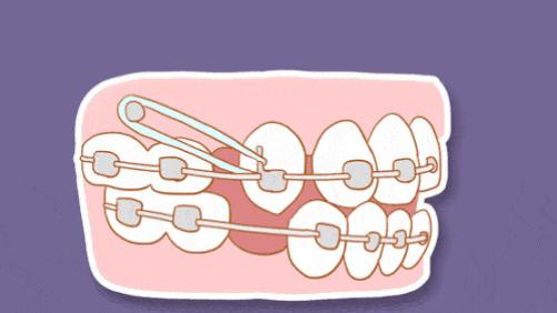 山药|为什么有些人矫正完会反弹？矫正结束要注意哪些问题，牙医告诉你
