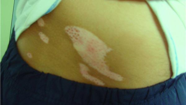 饮食|白癜风秋冬季饮食攻略