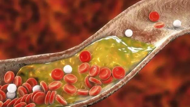 胆固醇|胆固醇“大户”被揪出，不是肥肉，医生：3物再不丢，脑梗或会找上门