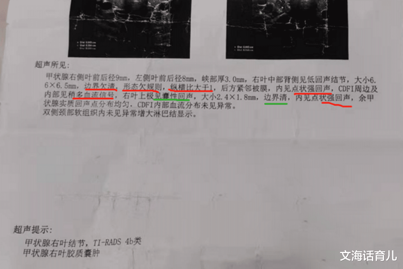 甲状腺结节有这2个特征, 恶化概率更高? 4个好习惯, 或有所改善