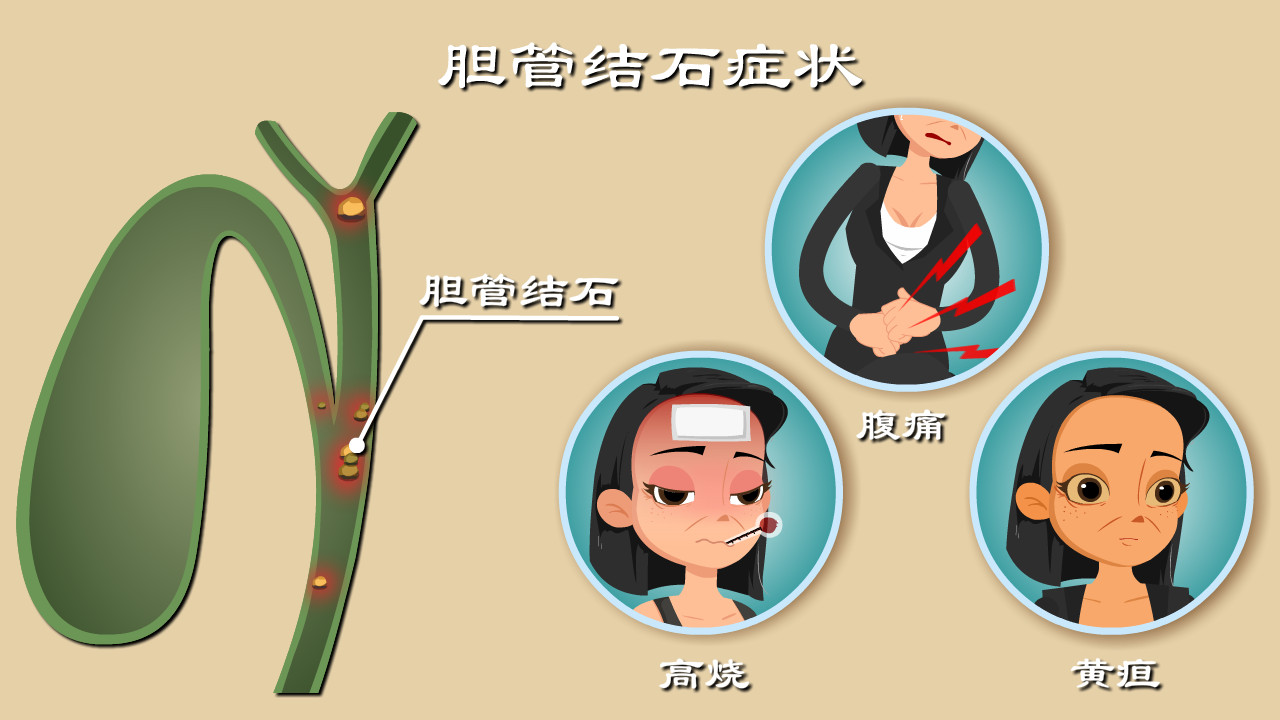 乳腺结节|六旬大爷多发胆管结石不自知，切肝保命！教你3招辨别胆管结石