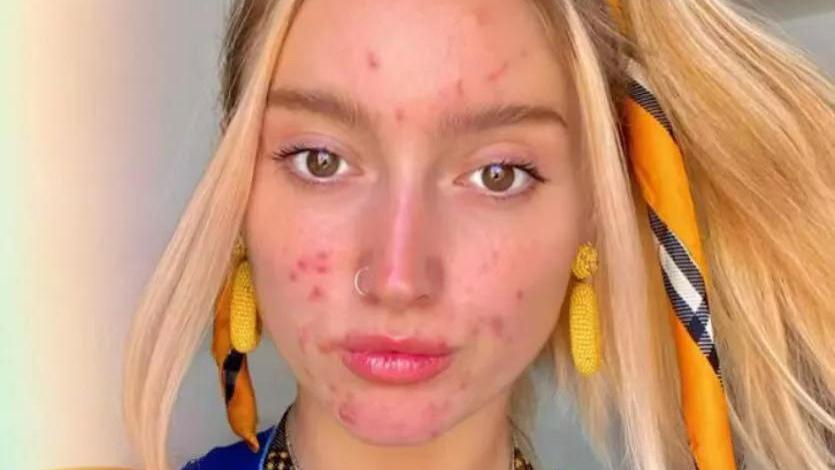 女孩|从完美皮肤到满脸爆痘，这个女孩的经历，让人想给她掌声