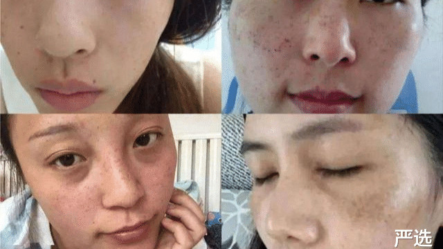 护手霜 泰国女子连续打了6年“美白针”，如今的变化，网友直呼不可思议