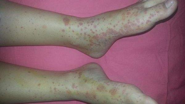 茄子|类风湿拖着不治疗？别等危害找上门才后悔！