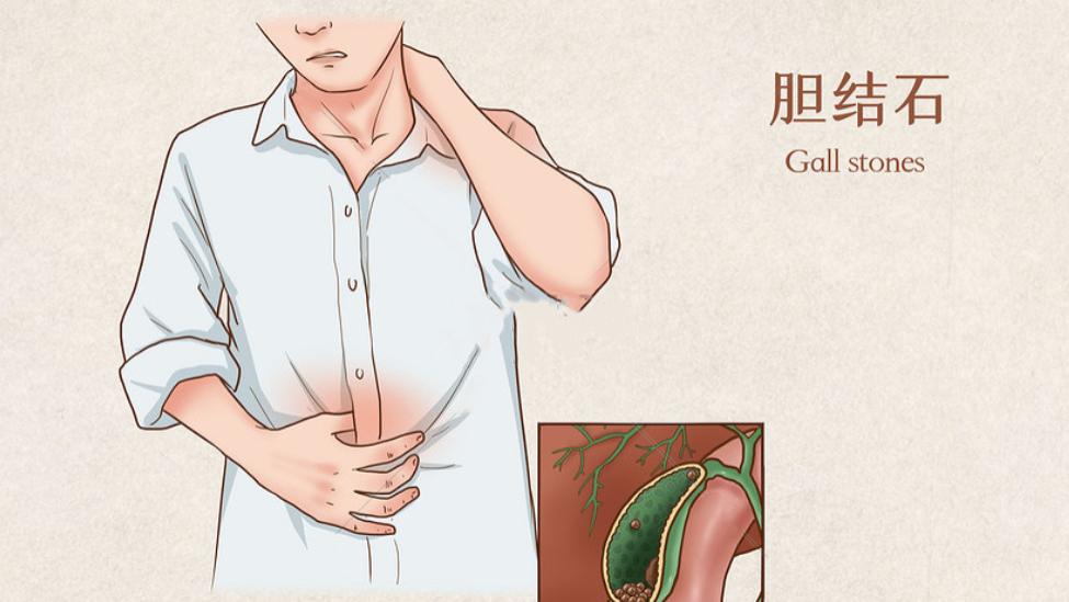 补品|结石，从来就不是突然出现的！