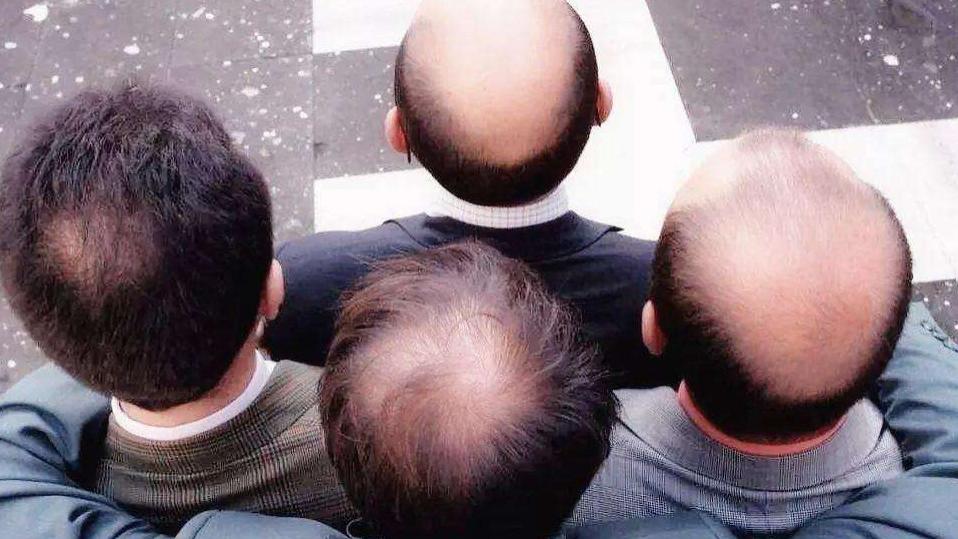脱发|这5类脱发高危人群，你的职业排行在内吗？