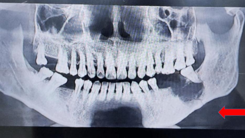 肠胃|血泪教训：拔牙前不拍片，拔完牙后竟痛到睡不着