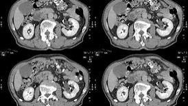 蛋白质|异常体重下降小心胰腺癌，发生重视身体的变化
