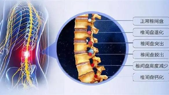 经络|注意这些信号的出现, 对早期发现腰椎病很重要!