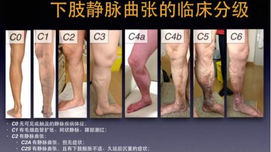 小凌|定性！定级！——你的腿部不适症状是下肢静脉曲张诱发吗？那你又属于哪一级！