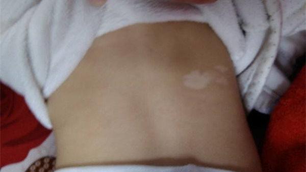 骨质疏松|冬季白癜风患者适宜吃什么？