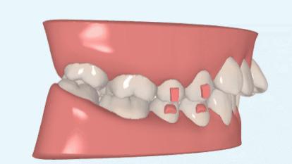 牙齿|推磨牙向后的病例，一定要选择隐形矫正吗？