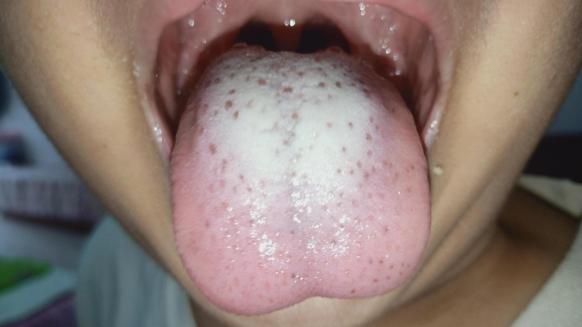 肿瘤|舌苔又白又厚，可能预示出现这五个问题，中医一次调正