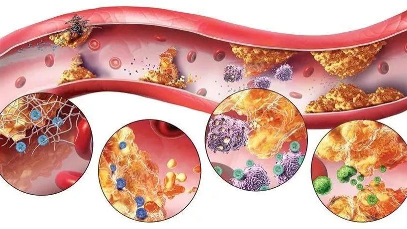 医生|血管“清道夫”已公开，63岁大爷仅用半年血脂恢复正常，医生连连夸赞