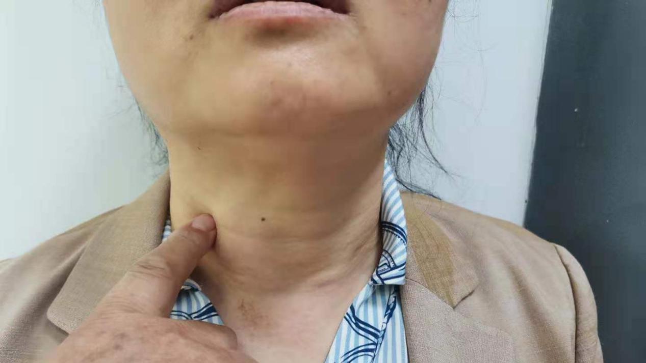 阳痿|46岁大姐，甲状腺结节1.8降到0.6，分享“3多”，方法值得借鉴