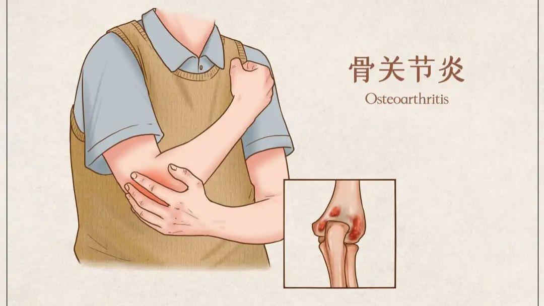 |世界关节炎日 | 别把膝痛不当回事，你知道它的“炎”重性吗？