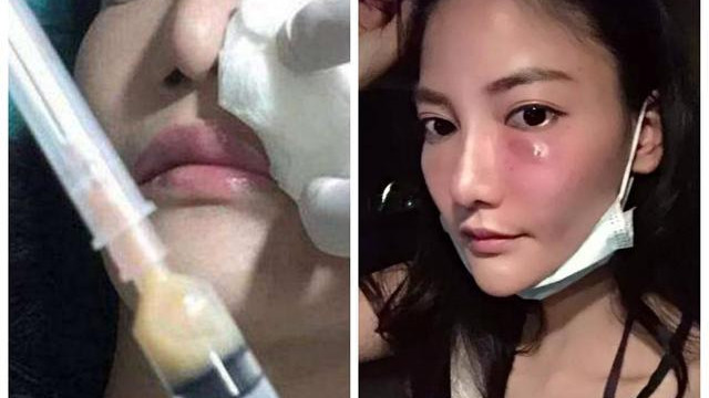 运动|6年前打美白针成“白灯泡”的女人，现在啥样，网友：还好没跟风