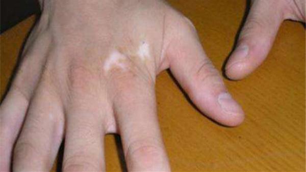 草莓|大夫，手关节处的白斑扩散了怎么办？