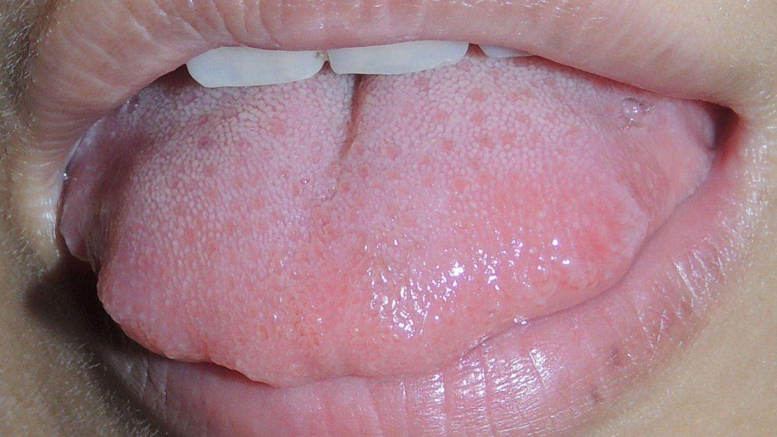 疾病|舌体胖大有齿痕，或是3种疾病在“报警”，中医教你如何正确调理