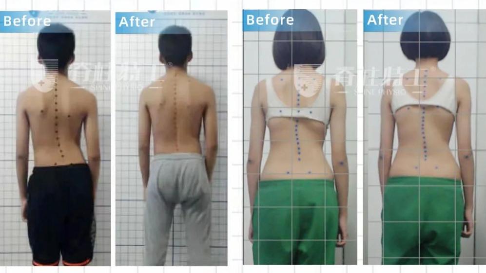 脊柱侧凸|脊柱侧弯，如何专业康复矫正？（收藏）