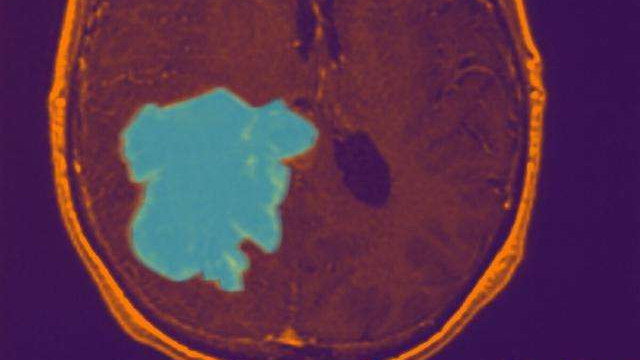 红斑狼疮|急性脑血管病脑出血发生概率高吗？?医学科普