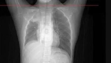 肾衰竭|12岁男孩咳嗽一周扛成白肺：专家会骗你，但身体永远不会“演戏”