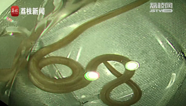 警惕! 女子长期肚子痛 一查肠道里长了条20cm的蛔虫