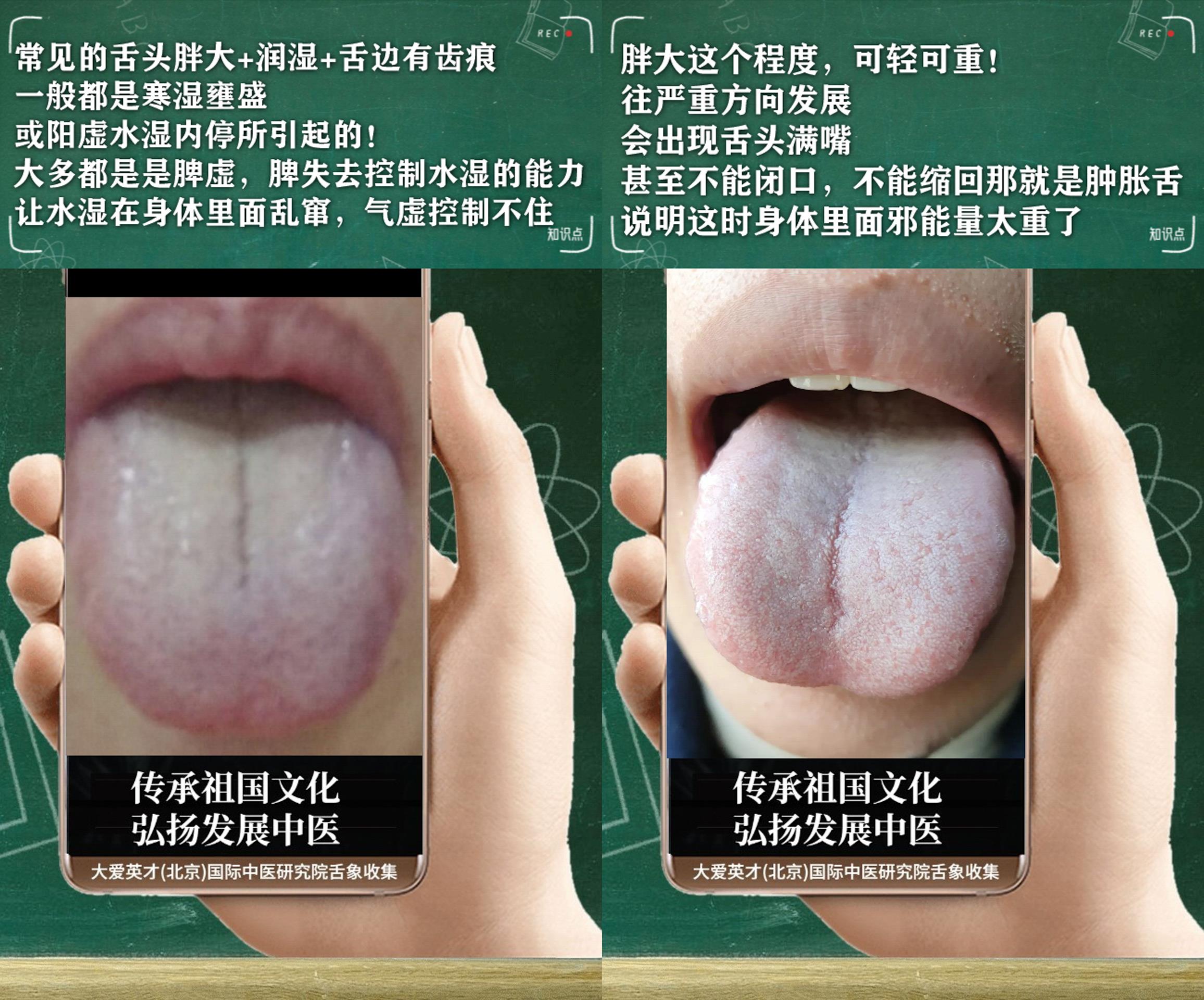 中医分析：易憋屈，易怒善郁，痰阻于心，断断续续很难受